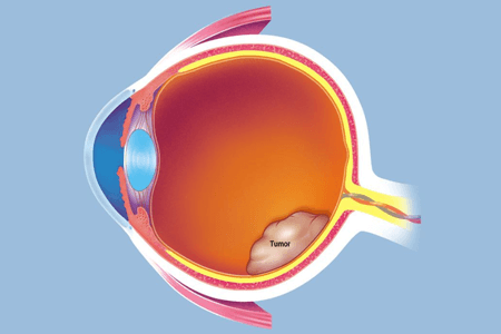 撅眼最快的治療方法是什么 需要如何防止復發? 撅眼最快的治療方法是什么 需要如何防止復發?