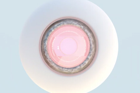 依鏡PRL晶體植入術注意事項,尤其第二步! 依鏡PRL晶體植入術注意事項,尤其第二步!