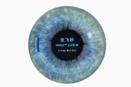 震驚!全飛秒手術后又近視了?專家教你這樣做 震驚!全飛秒手術后又近視了?專家教你這樣做